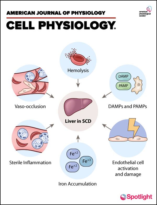 Molecular mechanisms of hepatic dysfunction in sickle cell disease 